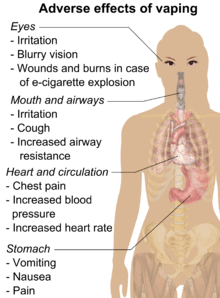 Serious adverse effects of vaping include corneoscleral lacerations or ocular burns or death after e-cigarette explosion. Less serious adverse effects of vaping include eye irritation, blurry vision, throat irritation, coughing, increased airway resistance, chest pain, increased blood pressure, increased heart rate, nausea, vomiting, and abdominal pain. Other adverse effects include eye irritation and blurry vision.