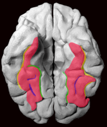 The Fusiform gyrus with all major sulci delimiting it, displayed on a 3D-printed brain of a healthy adult. As we view the brain from below, the right hemisphere is on the left side of the image