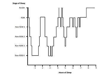 Example hypnogram for a normal, healthy adult. Within the first hour of sleep SWS is displayed. Cycles of REM and NREM sleep proceed. During the third cycle of sleep there are two brief wake states. During the second half of the sleep period more REM sleep is displayed and there is little SWS detected.