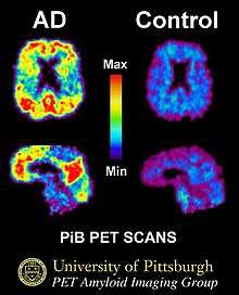 Image showing large areas of red and yellow in the "AD" brain on the left and no apparent red or yellow in the "Control" brain on the right.