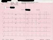 An ECG showing a SV extrasystole.