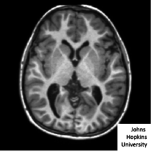 Two-dimensional scalar image depicting a section through a 3D brain at the level of the subcortical structures showing white, gray and CSF matter.